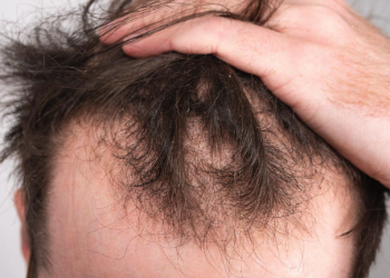 탈모에 대한 혁신적인 솔루션